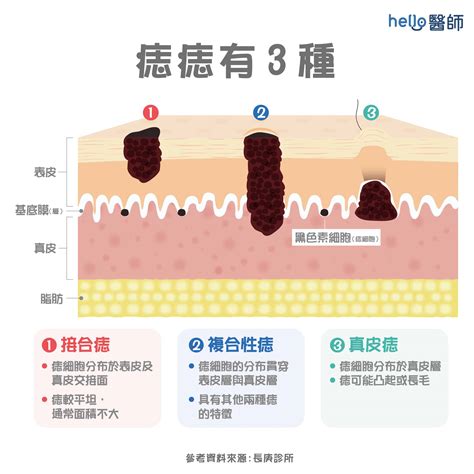 痣 形成原因|為什麼臉上的痣越來越多？皮膚科醫師解析長痣原因、。